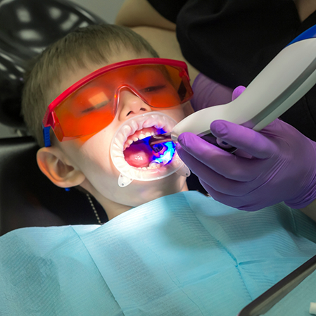 Young boy in the dental chair receiving dental sealants on his teeth