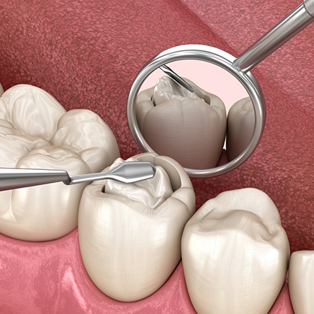 Illustration of dental instruments removing part of a tooth