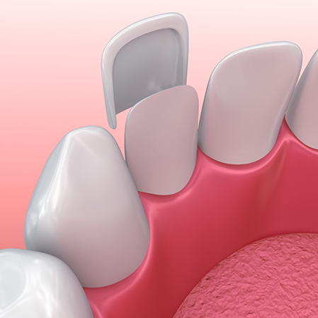 Illustration of a veneer being placed over the front surface of a tooth