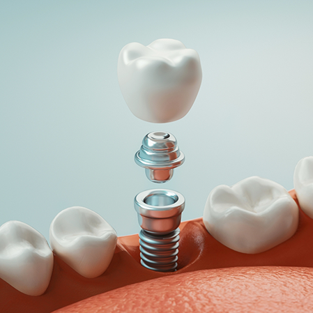 Illustration of a dental implant and a crown being placed in the lower jaw