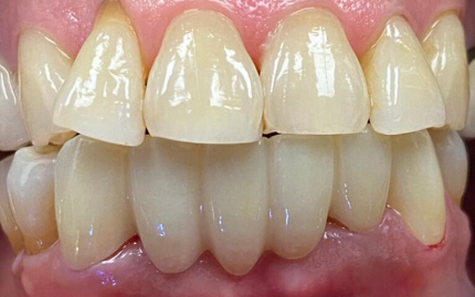 Close up of a mouth after replacing one missing lower tooth