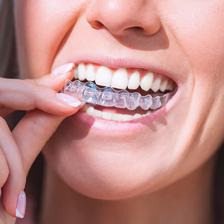 Close up of a person placing an Invisalign aligner over their teeth