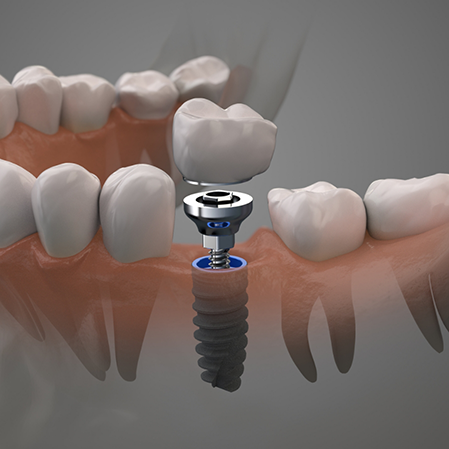 Illustration of a dental implant and a crown replacing a missing lower tooth