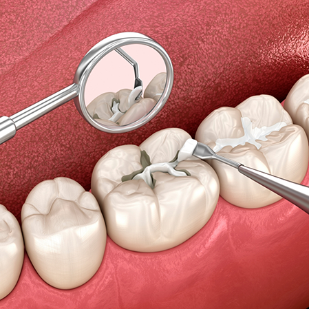 Illustration of a white filling being placed in a tooth