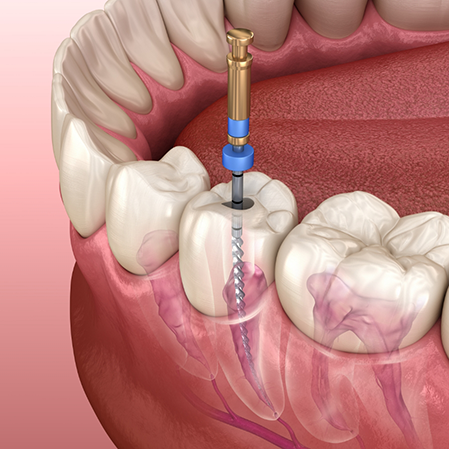 Illustration of a thin dental instrument treating the innermost layer of a tooth