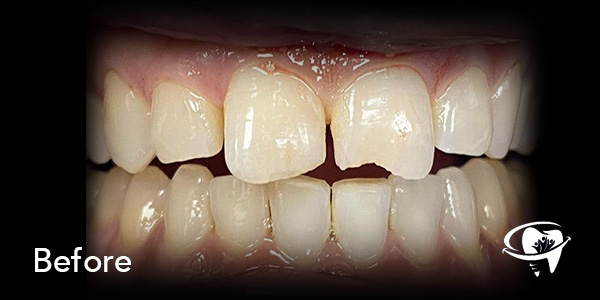 Close up of a mouth with a chipped tooth and some misshapen teeth