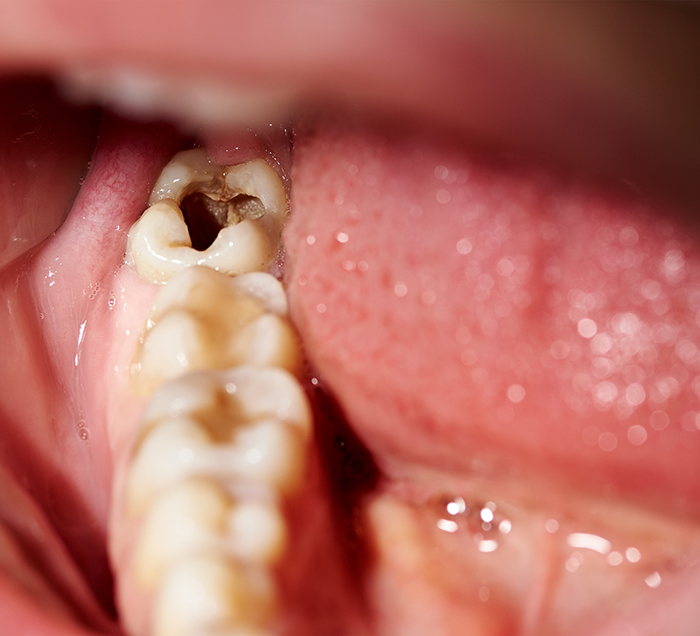 Close up of a blackened tooth that needs tooth extraction in San Antonio