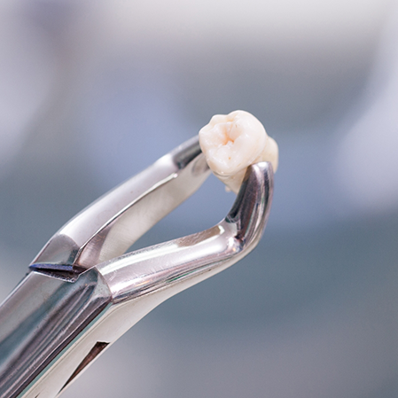 Dental clasps holding an extracted tooth