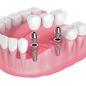 Illustration of three-unit dental implant bridge