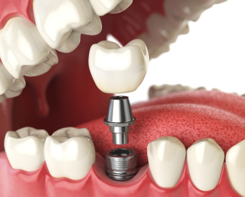 san antonio tooth implant